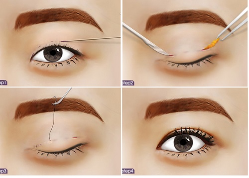 Bấm mí mắt Hàn Quốc là kỹ thuật tạo ra đôi mắt hai mí rất đơn giản