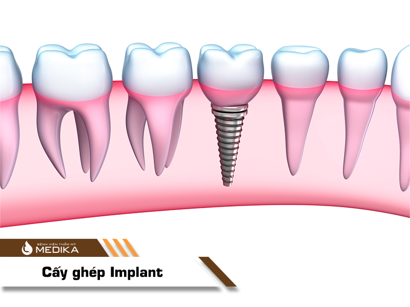 Cấy ghép Implant là phương pháp phục hình răng đã mất