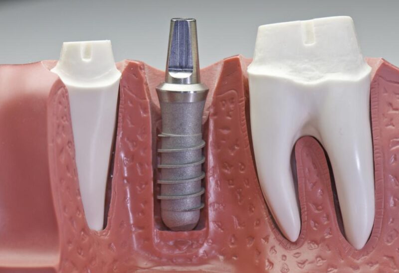 Cấy răng Implant duy trì được bao lâu?
