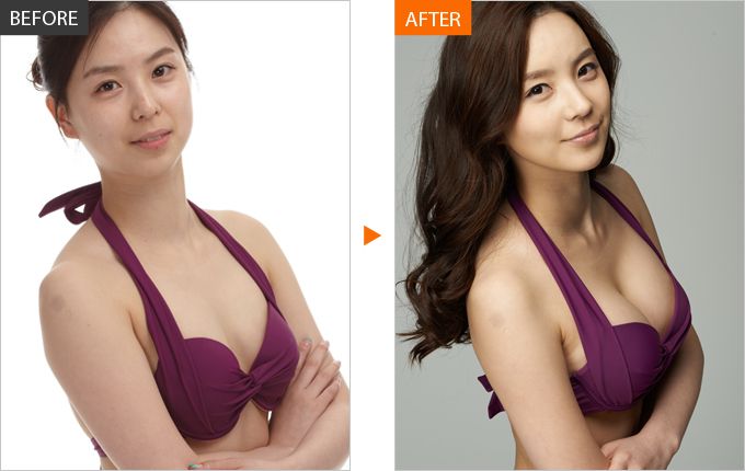 Phẫu thuật vòng 1 hỏng giúp chị em tái tạo lại khuông ngực hư