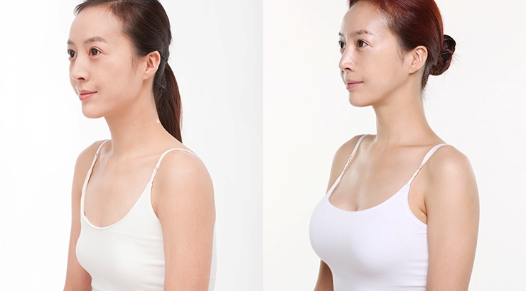Chỉnh sửa ngực hỏng tái tạo khuôn ngực đẹp như mới
