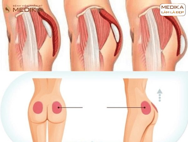 Chụp cắt lớp Nâng vòng 3 bơm mông độn mông ở Bệnh viện thẩm mỹ MEDIKA