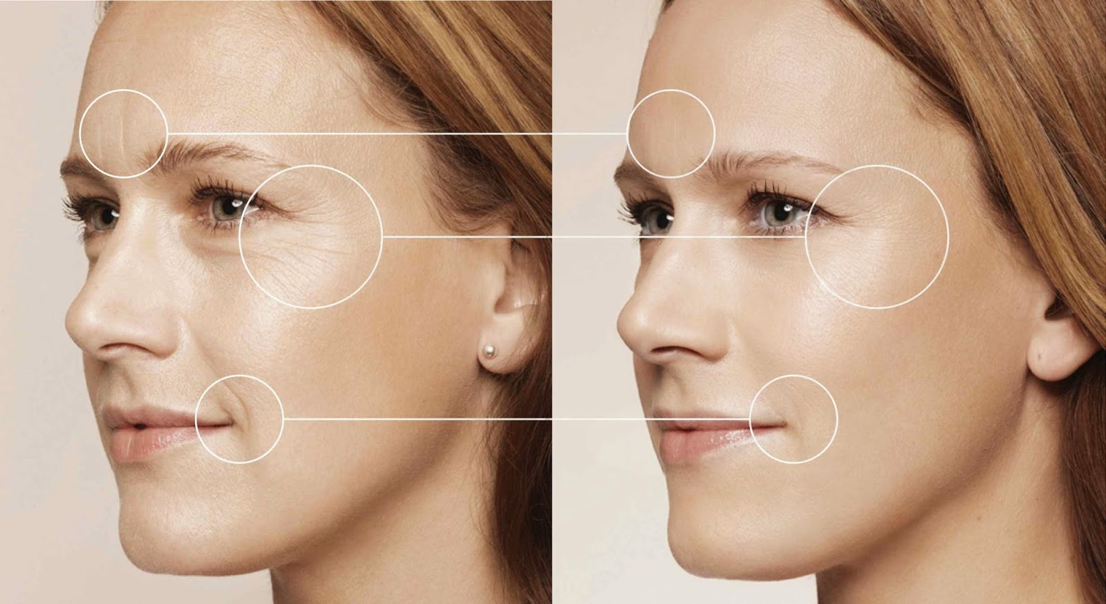 điều trị da bằng spectra laser