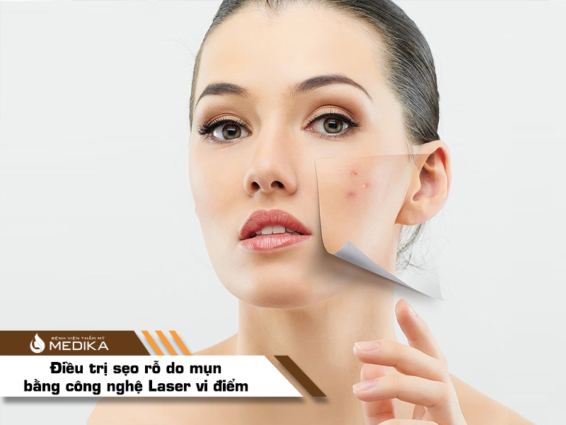 điều trị sẹo rỗ