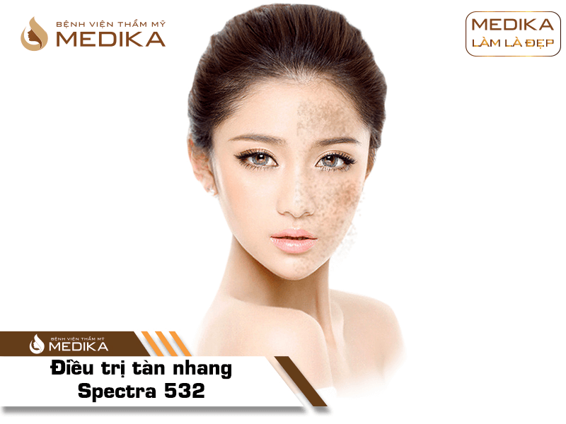 Điều trị tàn nhang Spectra 532 ở Bệnh viện thẩm mỹ MEDIKA