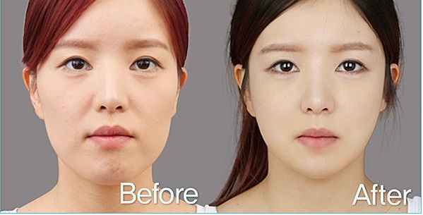 co-phuong-phap-nao-hieu-qua-hon-hut-mo-nong-cam-khong Có phương pháp nào hiệu quả hơn hút mỡ nọng cằm không?