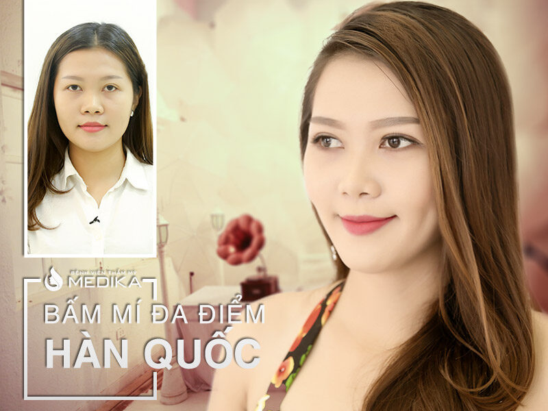 Kết quả bấm mí đa điểm Hàn Quốc