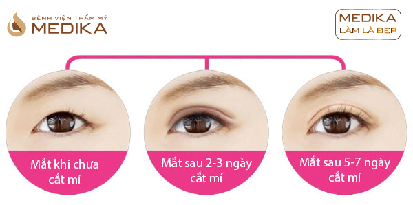 Lý do khiến cho các chị em sợ cắt mắt 2 mí?