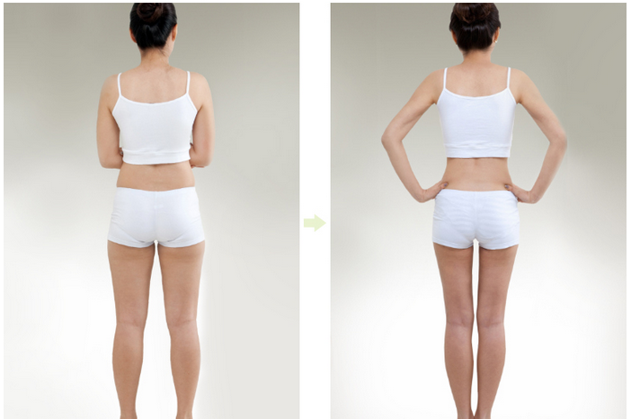 nguy-hiem-khi-hut-mo-loi-don-co-phai-that Nguy hiểm khi hút mỡ - Lời đồn có phải thật ?