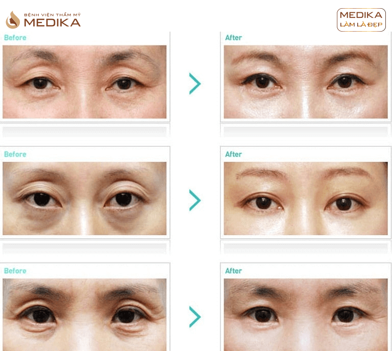 lay-mo-mi-mat-co-the-thuc-hien-dong-thoi-cat-mi Lấy mỡ mí mắt có thể thực hiện đồng thời cắt mí