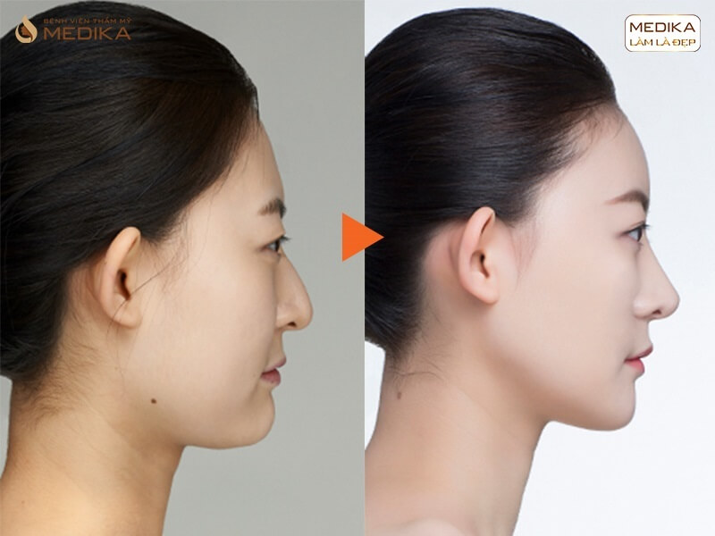 Kết quả quá trình nâng mũi sụn sườn - MEDIKA.vn