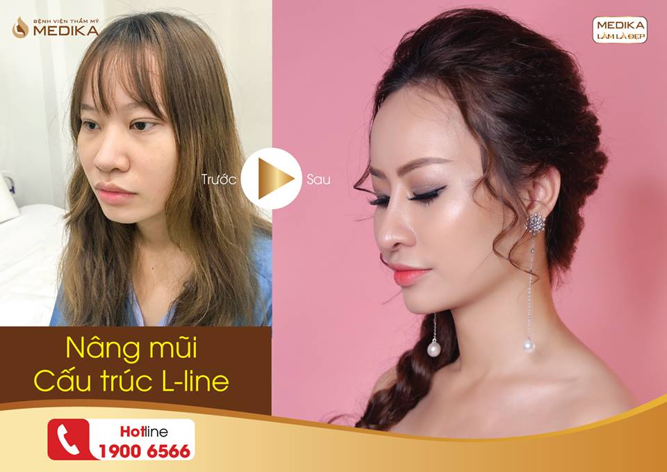 Dáng mũi L line chuẩn cao tây - Niềm mơ ước của mọi chị em