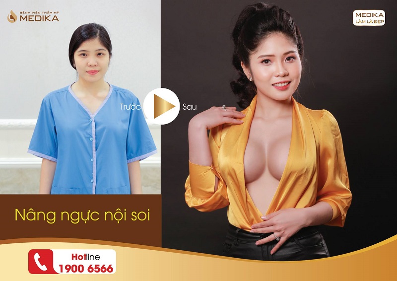 Khách hàng nâng ngực nội soi tại Bệnh viện thẩm mỹ MEDIKA