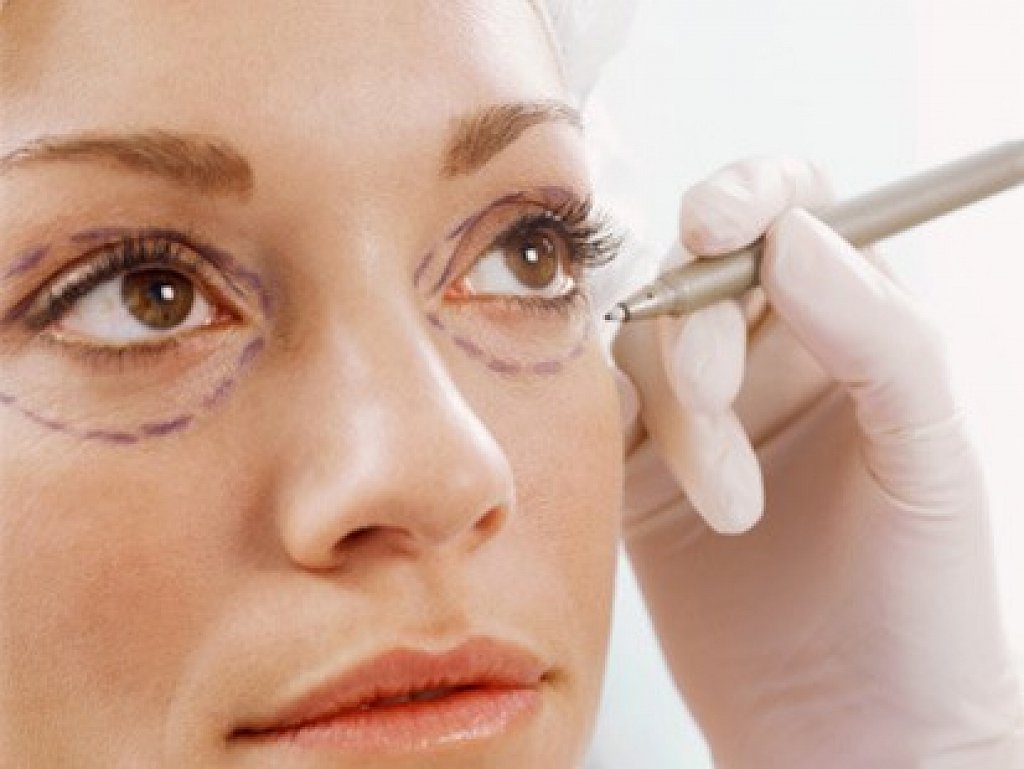 Tiểu phẫu lấy mỡ mí mắt và cắt da thừa ở MEDIKA