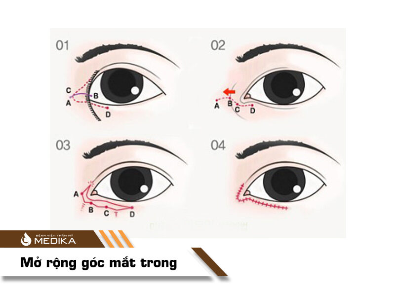 Mở rộng góc mắt trong tại MEDIKA