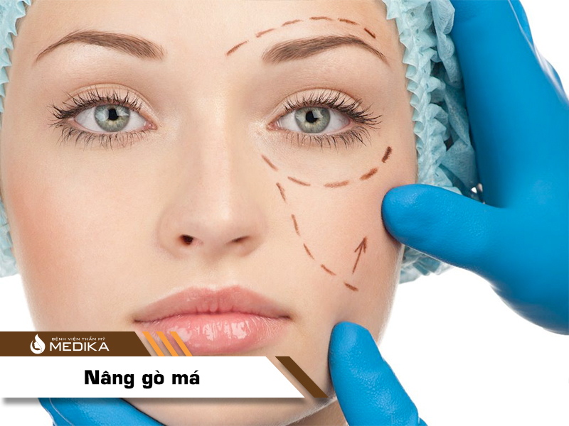 Nâng gò má ở Bệnh viện thẩm mỹ MEDIKA