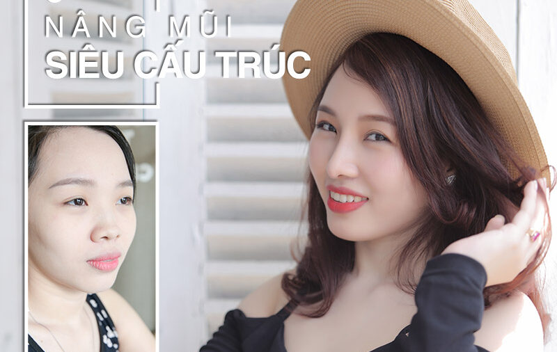 Cùng MEDIKA khám phá những màn lột xác ngoạn mục nhờ nâng mũi