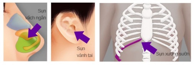 Nâng mũi bằng sụn sườn giải pháp tối ưu cho mũi hoàn hảo
