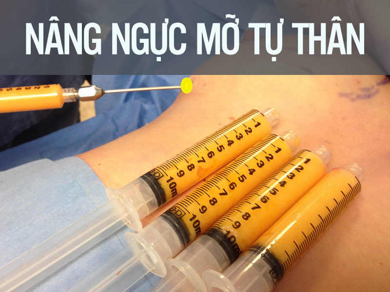 Bơm ngực bằng mô mỡ - còn gọi là nâng ngực bằng mỡ tự thân