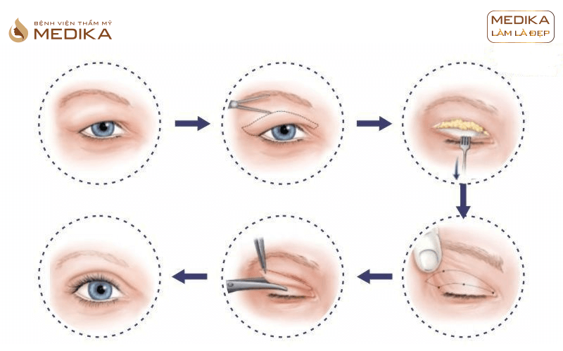 Góc chia sẻ bí quyết lấy mỡ mí mắt trẻ hóa mắt hiệu quả