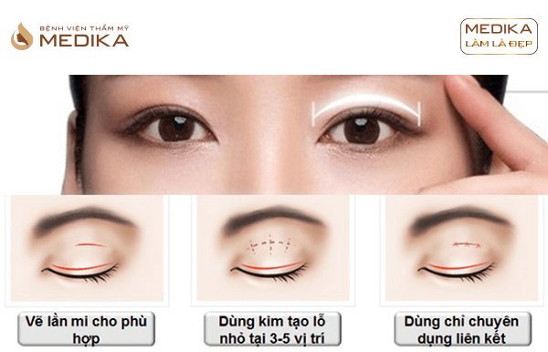 Phương pháp Bấm mí mắt đa điểm Hàn Quốc ở Bệnh viện thẩm mỹ MEDIKA