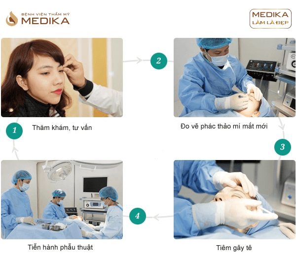 Quy trình Bấm mí đa điểm Châu Âu ở Bệnh viện thẩm mỹ MEDIKA