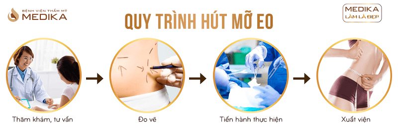 Quy trình Hút mỡ eo ở Bệnh viện thẩm mỹ MEDIKA