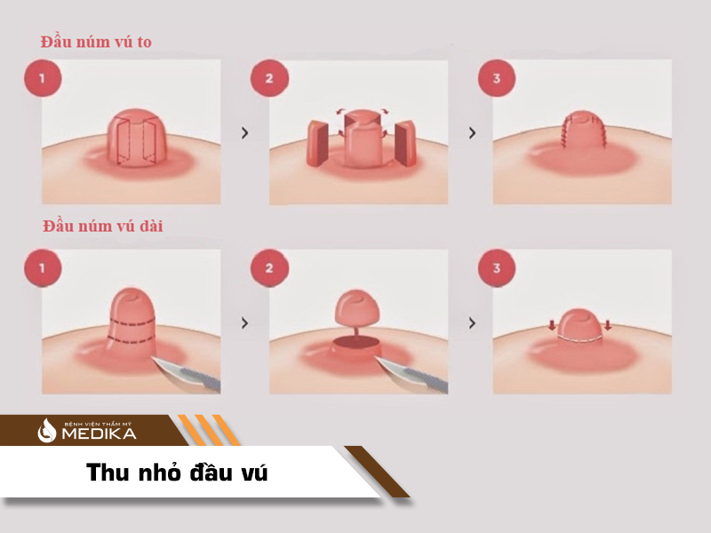 Tuyến sữa có bị ảnh hưởng khi làm nhỏ nhũ hoa? tuyen-sua-co-bi-anh-huong-khi-lam-nho-nhu-hoa