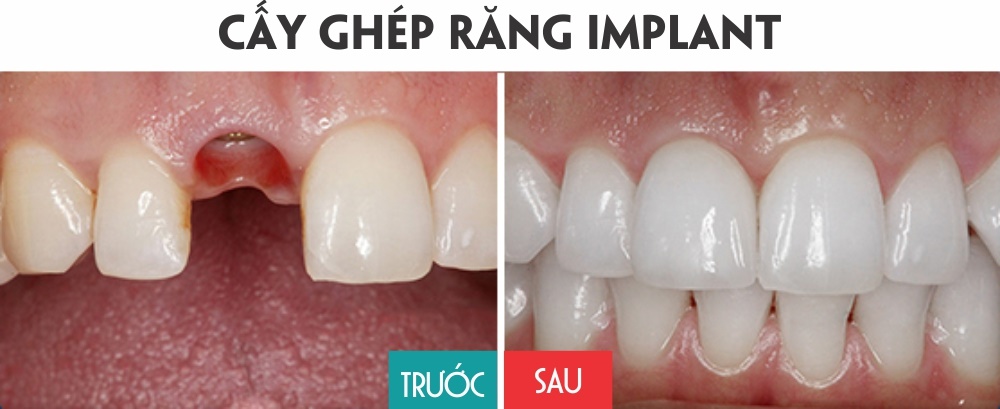 Cải thiện hàm răng chưa hoàn hảo nhờ phương pháp cấy implant