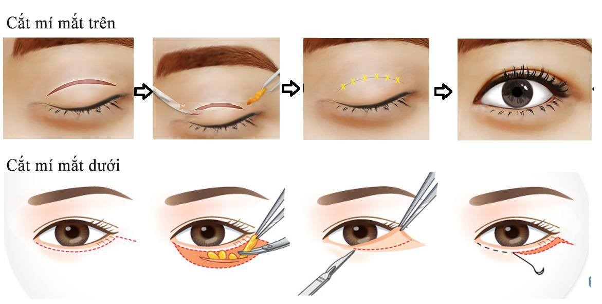 Phẫu thuật cắt mí mắt các bác sĩ sẽ rạch một đường nhỏ trùng với nếp gấp mí của bạn