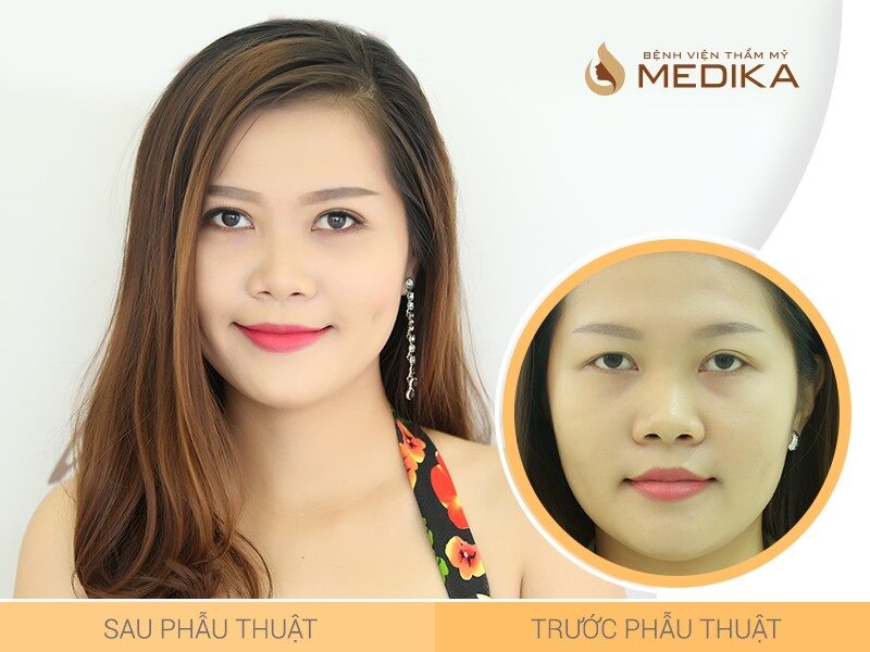 Phẫu thuật cắt mí mắt là tiểu phẫu cắt mắt 2 mí ít sưng, mau lành, hồi phục nhanh