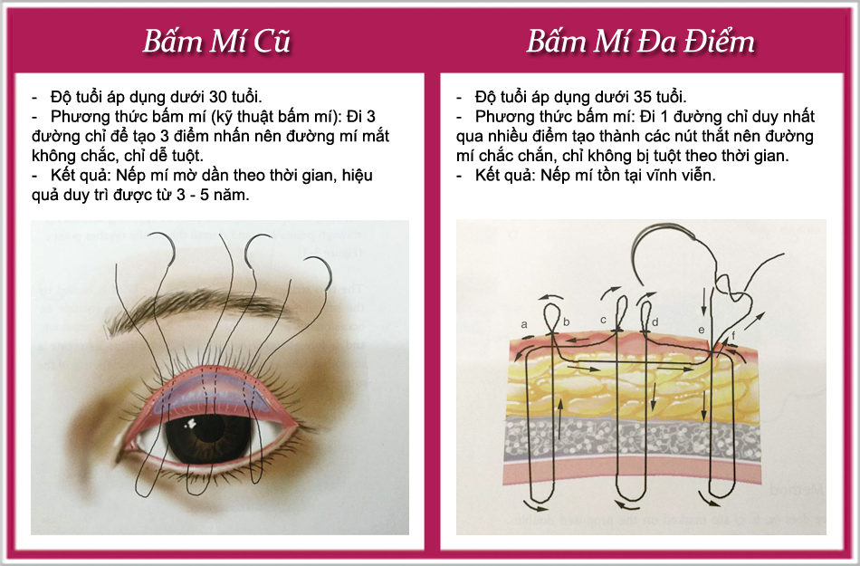 So sánh bấm mí đa điểm hàn quốc và bấm mí thường