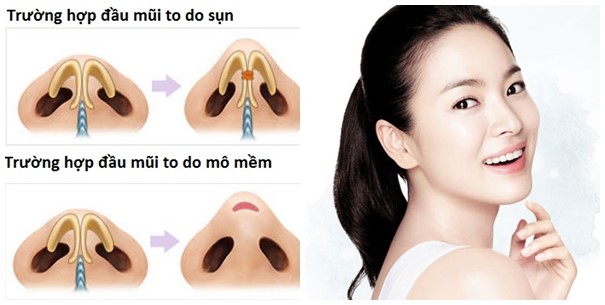 Tùy dáng mũi có sẵn và cơ địa của khách hàng mà bác sĩ sẽ áp dụng cách làm thon gọn mũi khác nhau
