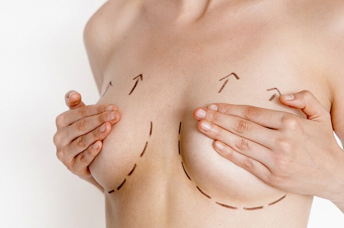 Treo sa trễ ngực không cần phẫu thuật
