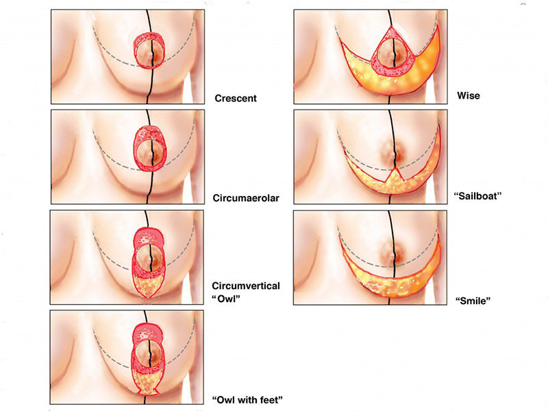 nâng ngực chảy xệ