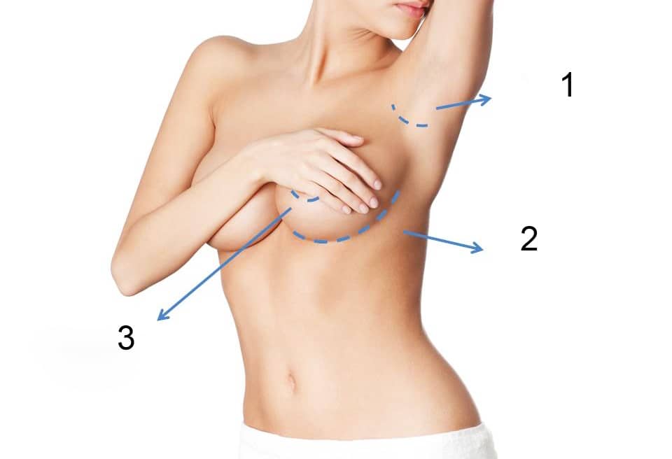 Phẫu thuật nâng ngực bằng đường nào tốt hơn?