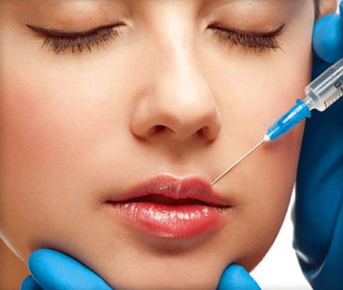 Phương pháp tiêm Filler môi giúp cho đôi môi căng mọng