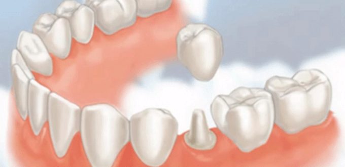 Có nên trồng răng sứ cho răng đã lấy tủy?