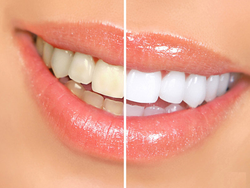 Những điều cần biết về tẩy trắng răng để không tốn tiền vô ích