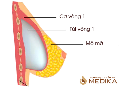 Nâng ngực nội soi và vị trí đặt túi độn nâng ngực