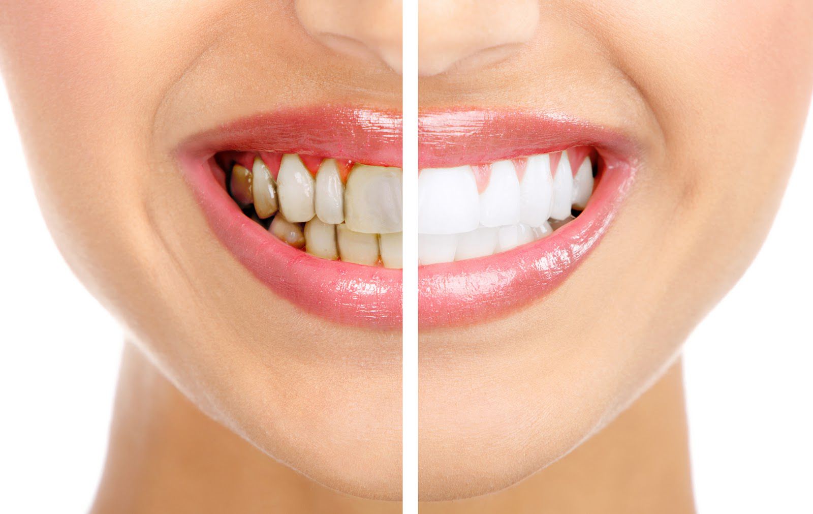 Tẩy trắng răng có ảnh hưởng đến chức năng hàm răng không?