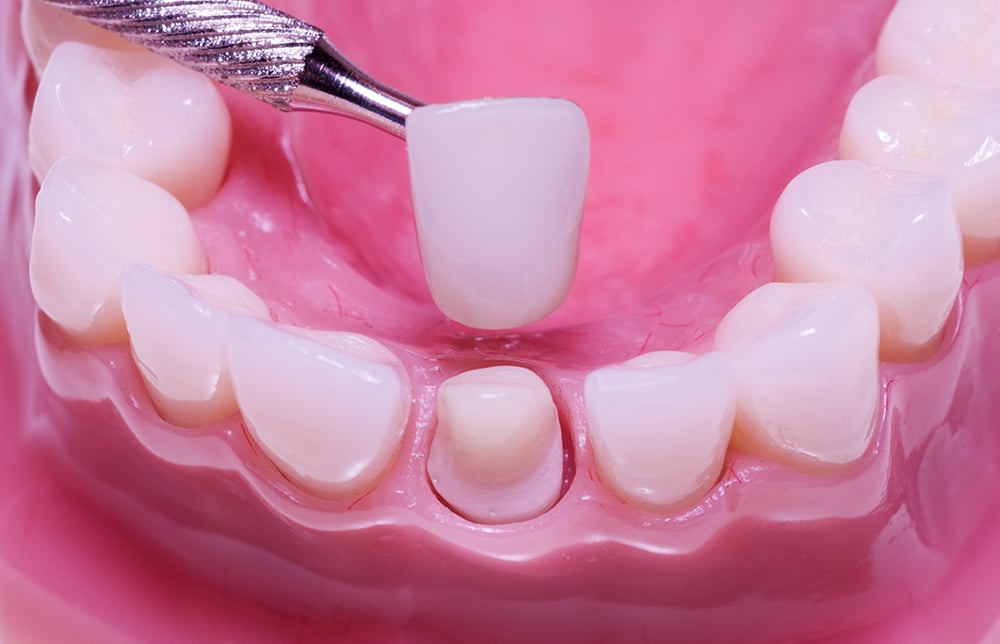 Bọc răng sứ là phương pháp khôi phục răng