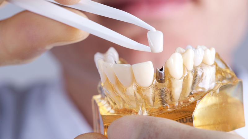 Trồng răng Implant có mắc không? Giá bao nhiêu?
