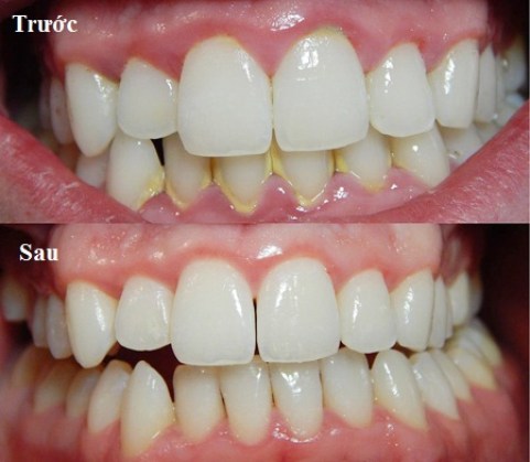 Cao răng không lấy thường xuyên tích tụ lại gây viêm nướu