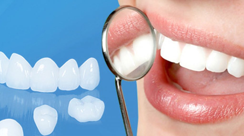 Bọc răng sứ là phương pháp giúp phục hình răng