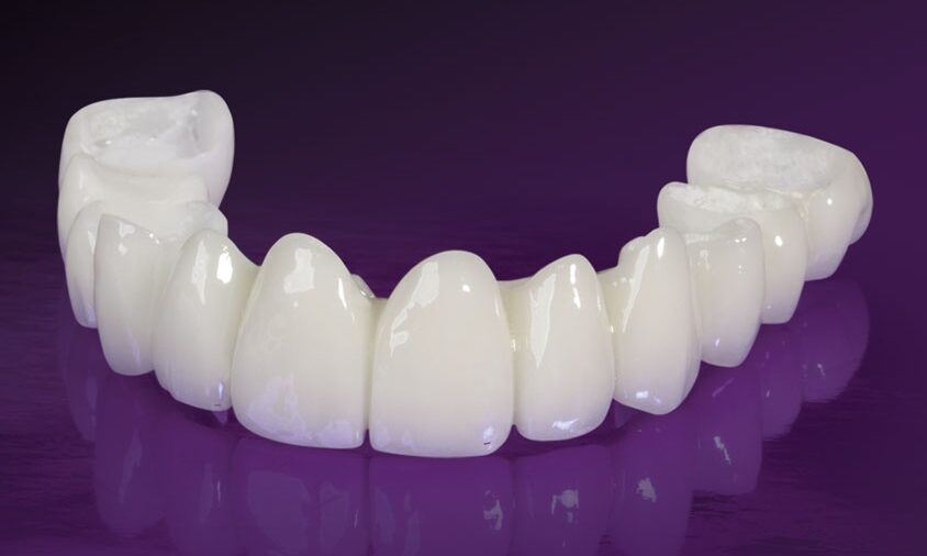 Bọc răng toàn sứ - Tạm biệt nỗi lo chân răng bị đen