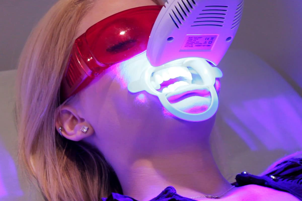 Tẩy trắng rắng bằng laser là là phương pháp tẩy trắng răng được nhiều người ưa chuộng