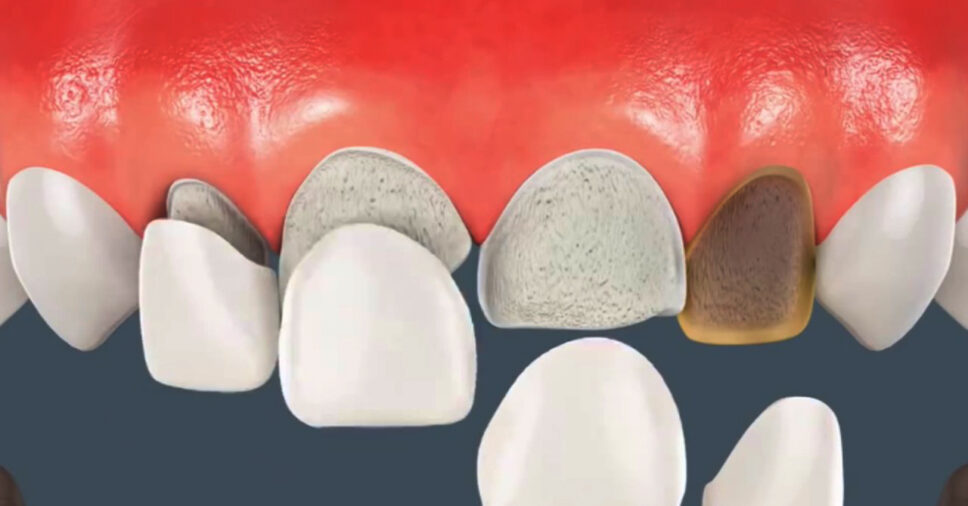 Dán răng sứ thẩm mỹ có bền không?