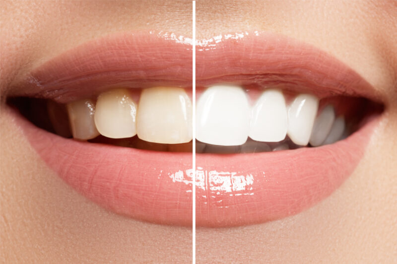 Bật mí cách làm trắng răng tức thì bằng các nguyên liệu dễ tìm