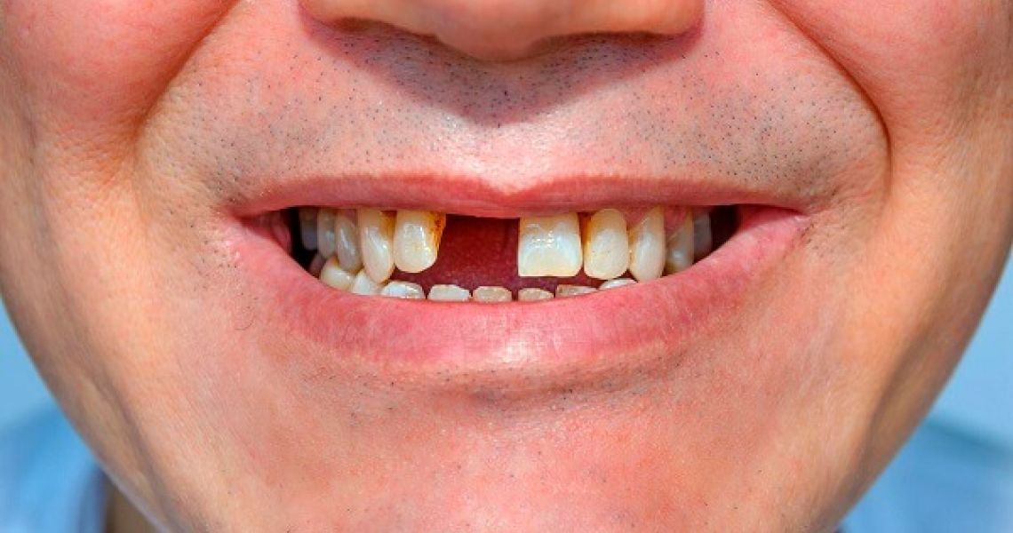 Mất răng nên làm cầu răng sứ hay trồng răng Implant